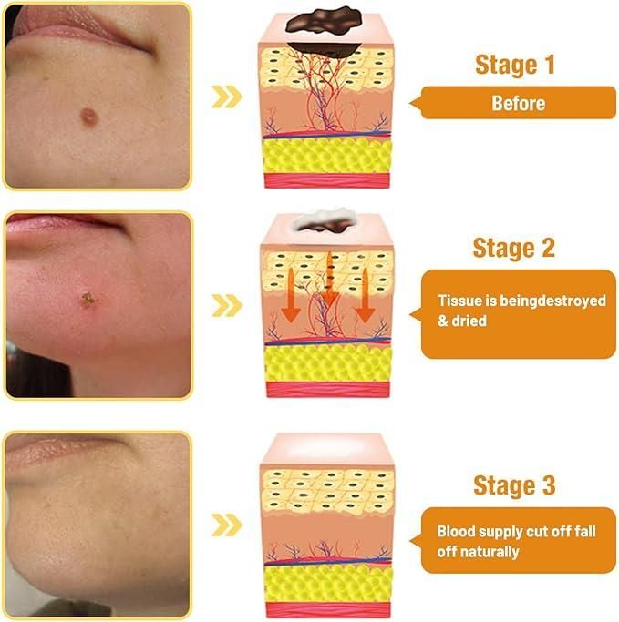Bee Venom Wart & Mole Removal Cream (Pack of 2)